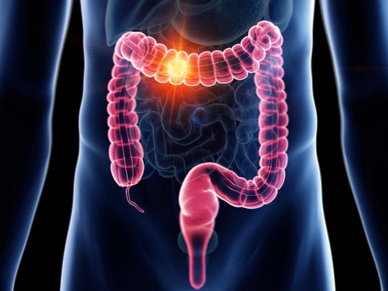 Cirurgia Robótica para Doenças Inflamatórias Intestinais